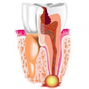 periodontit2-180x180-1